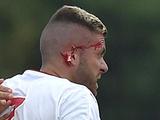 Менезу оторвали кусок уха в первом матче за «Бордо» (ФОТО) 